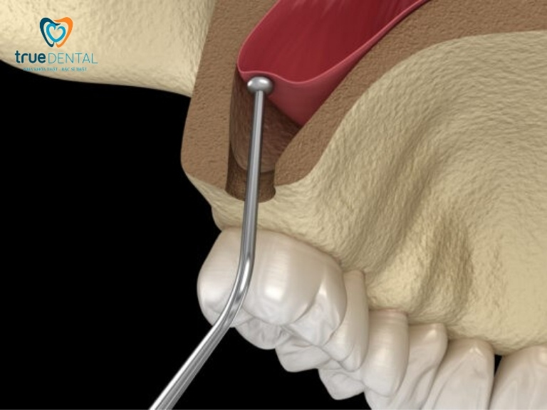 TRƯỜNG HỢP NÀO CẦN NÂNG XOANG HÀM TRONG CẤY GHÉP RĂNG IMPLANT? 1 Nâng xoang hàm là gì?