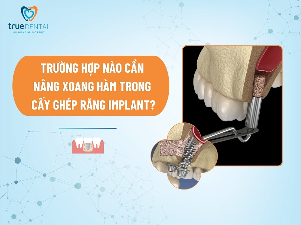 TRƯỜNG HỢP NÀO CẦN NÂNG XOANG HÀM TRONG CẤY GHÉP RĂNG IMPLANT? 10 TRƯỜNG HỢP NÀO CẦN NÂNG XOANG HÀM TRONG CẤY GHÉP RĂNG IMPLANT?