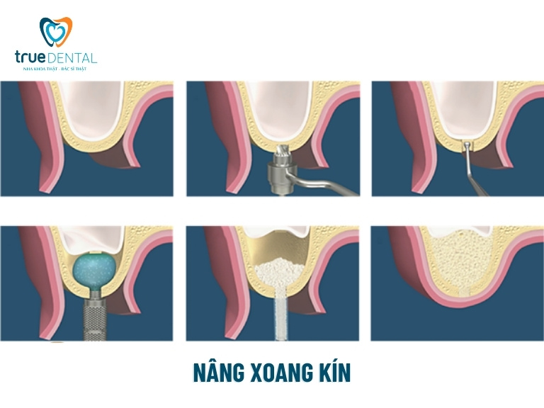 TRƯỜNG HỢP NÀO CẦN NÂNG XOANG HÀM TRONG CẤY GHÉP RĂNG IMPLANT? 5 Nâng xoang kín