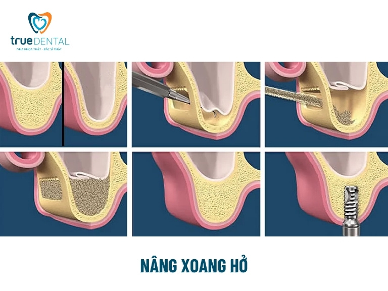 TRƯỜNG HỢP NÀO CẦN NÂNG XOANG HÀM TRONG CẤY GHÉP RĂNG IMPLANT? 4 Nâng xoang hở