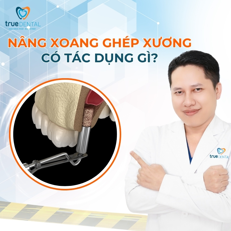 TRƯỜNG HỢP NÀO CẦN NÂNG XOANG HÀM TRONG CẤY GHÉP RĂNG IMPLANT? 2 Tác dụng khi Nâng xoang hàm trong cấy ghép Implant