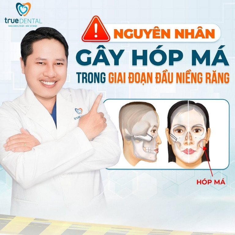 BỊ HÓP MÁ, HÓP THÁI DƯƠNG KHI NIỀNG RĂNG: NGUYÊN NHÂN VÀ CÁCH KHẮC PHỤC 2 Nguyên nhân gây hóp má, hóp thái dương khi niềng răng
