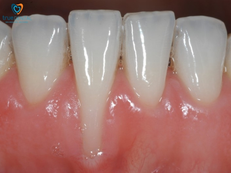 NIỀNG RĂNG BỊ TỤT LỢI: NGUYÊN NHÂN VÀ CÁCH ĐIỀU TRỊ 1 Niềng răng bị tụt lợi