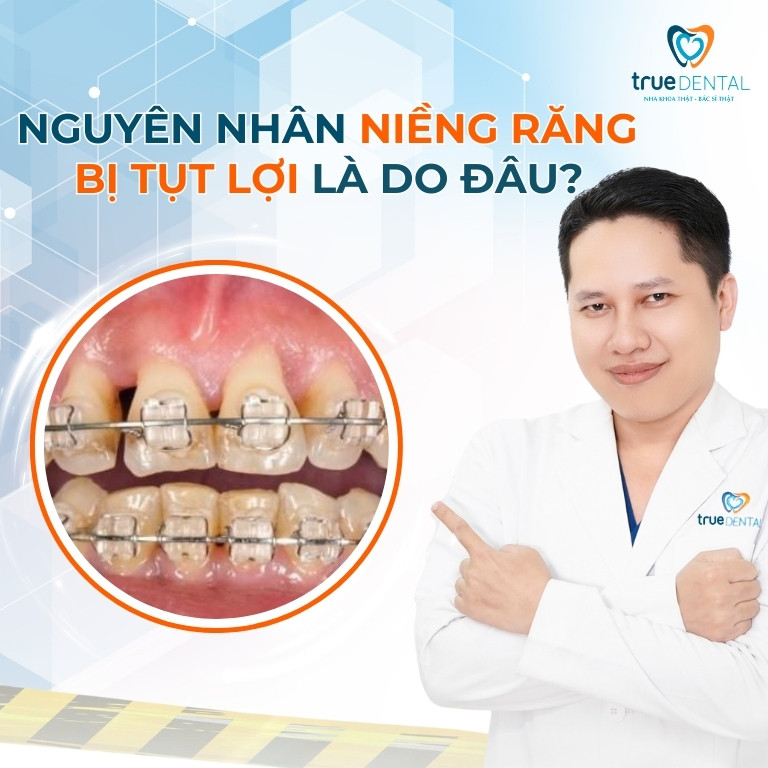 NIỀNG RĂNG BỊ TỤT LỢI: NGUYÊN NHÂN VÀ CÁCH ĐIỀU TRỊ 2 Nguyên nhân dẫn đến niềng răng bị tụt lợi là do đâu?