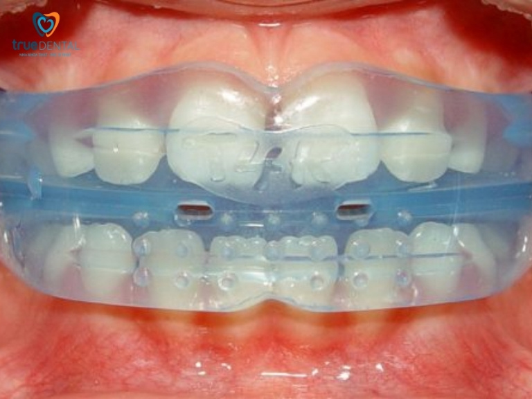 NIỀNG RĂNG CHO TRẺ EM: LỢI ÍCH VÀ NHỮNG LƯU Ý CẦN BIẾT 2 độ tuổi chỉnh nha cho bé
