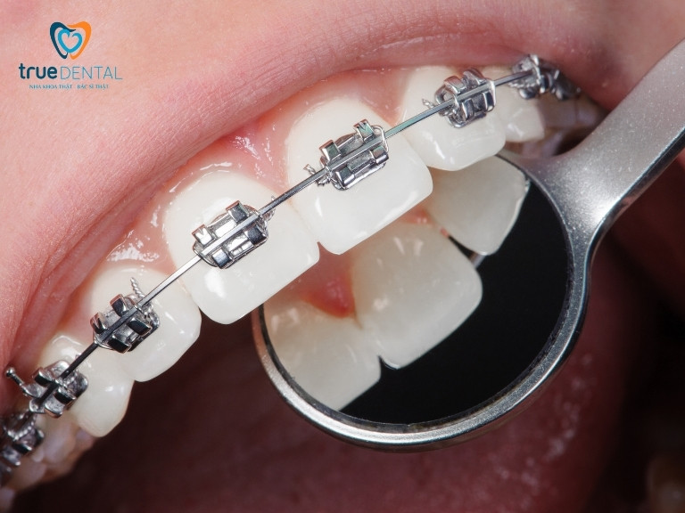 NIỀNG RĂNG CÓ ĐAU KHÔNG? GIAI ĐOẠN ĐAU NHẤT VÀ CÁCH GIẢM ĐAU 1 Niềng răng là gì, có đau không
