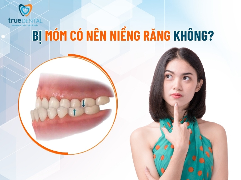 NIỀNG RĂNG MÓM CÓ HIỆU QUẢ KHÔNG? BAO LÂU THÌ HẾT MÓM 2 Bị móm có nên niềng răng không?