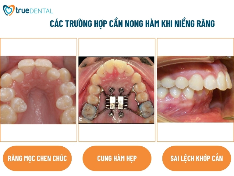 NONG HÀM LÀ GÌ? VÌ SAO PHẢI NONG HÀM KHI NIỀNG RĂNG? 3 trường hợp nào cần nong hàm khi niềng răng