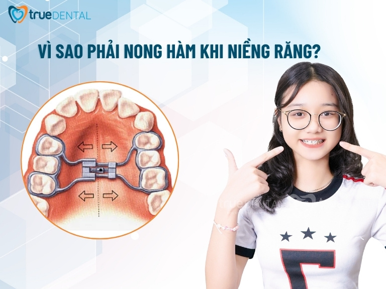 NONG HÀM LÀ GÌ? VÌ SAO PHẢI NONG HÀM KHI NIỀNG RĂNG? 2 Vì sao phải nong hàm khi niềng răng