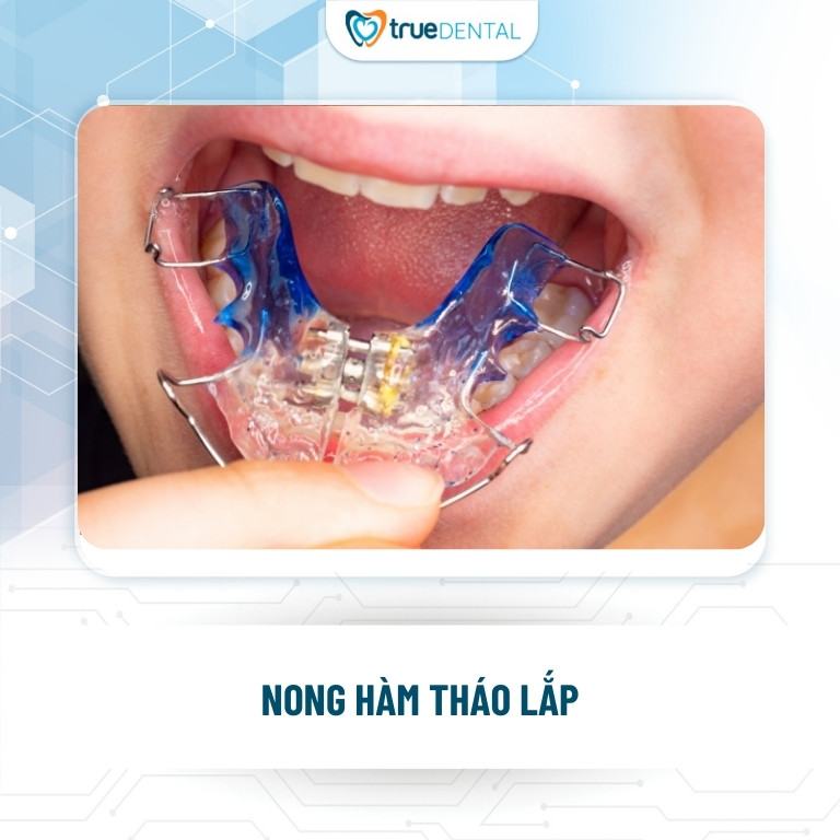 NONG HÀM LÀ GÌ? VÌ SAO PHẢI NONG HÀM KHI NIỀNG RĂNG? 4 Khí cụ nong hàm tháo lắp khi niềng răng