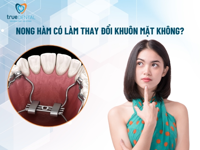 NONG HÀM LÀ GÌ? VÌ SAO PHẢI NONG HÀM KHI NIỀNG RĂNG? 6 Nong hàm khi niềng răng có làm thay đổi khuôn mặt không