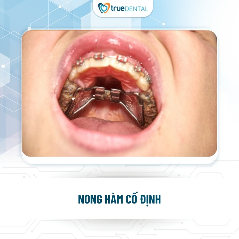 NONG HÀM LÀ GÌ? VÌ SAO PHẢI NONG HÀM KHI NIỀNG RĂNG? 5 khí cụ nong hàm cố định trong chỉnh nha