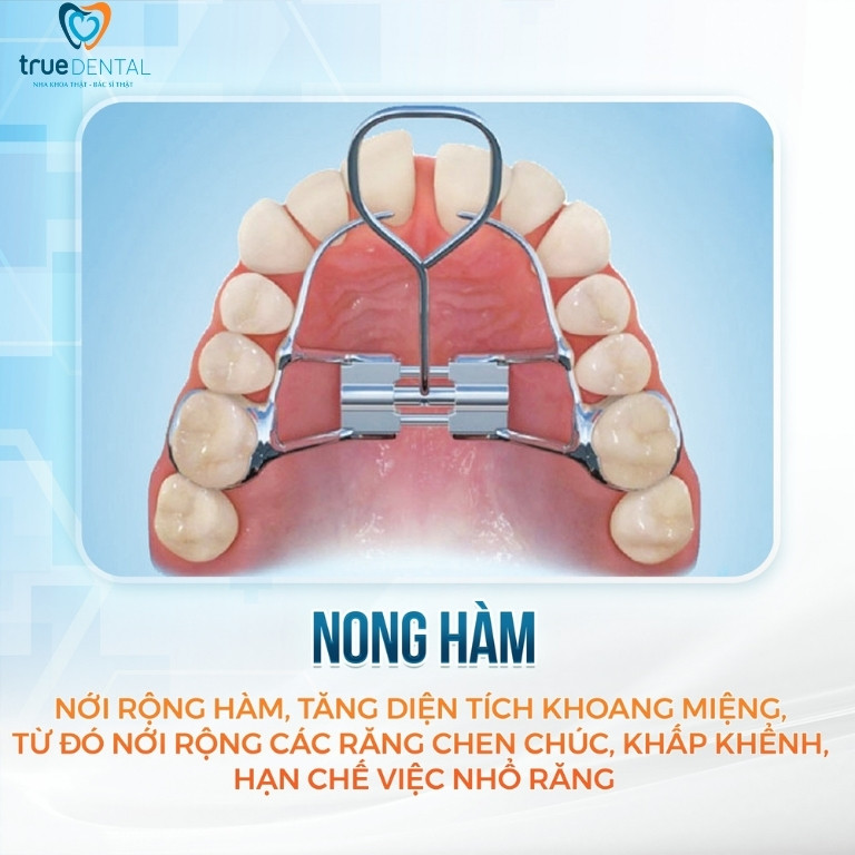 NONG HÀM LÀ GÌ? VÌ SAO PHẢI NONG HÀM KHI NIỀNG RĂNG? 1 Nong hàm là gì?