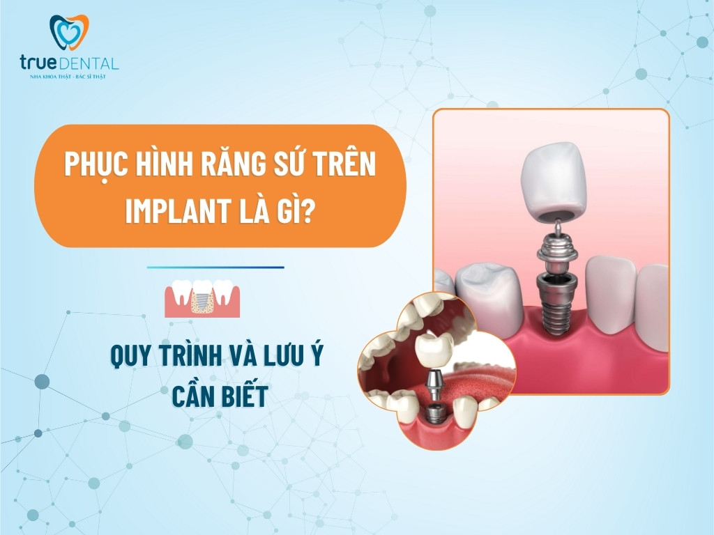 PHỤC HÌNH RĂNG SỨ TRÊN IMPLANT LÀ GÌ? QUY TRÌNH VÀ LƯU Ý CẦN BIẾT 3 PHỤC HÌNH RĂNG SỨ TRÊN IMPLANT LÀ GÌ? QUY TRÌNH VÀ LƯU Ý CẦN BIẾT