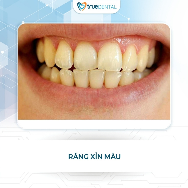 RĂNG BỊ XỈN MÀU DO ĐÂU? NGUYÊN NHÂN, CÁCH PHÒNG NGỪA VÀ KHẮC PHỤC 1 Răng bị xỉn màu