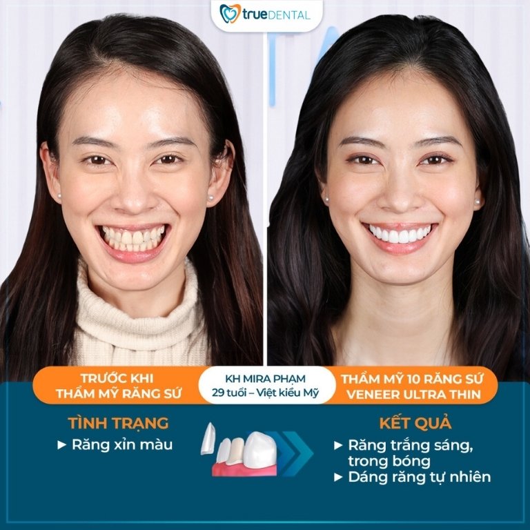 RĂNG BỊ XỈN MÀU DO ĐÂU? NGUYÊN NHÂN, CÁCH PHÒNG NGỪA VÀ KHẮC PHỤC 4 điều trị răng xỉn màu