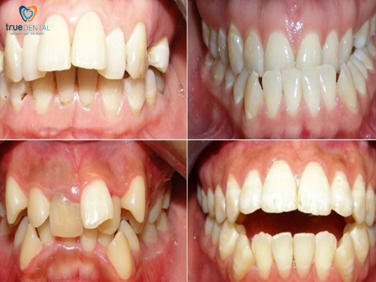 răng mọc lệch có nên thẩm mỹ răng sứ Veneer