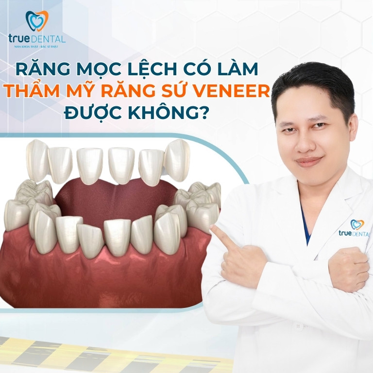 Răng mọc lệch có làm Thẩm mỹ răng sứ Veneer được không?