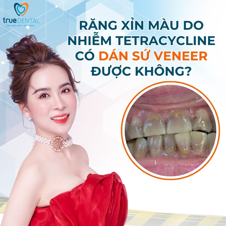 RĂNG XỈN MÀU DO NHIỄM TETRACYCLINE CÓ DÁN SỨ VENEER ĐƯỢC KHÔNG? 3 Răng xỉn màu do nhiễm Tetracycline có dán sứ Veneer được không?