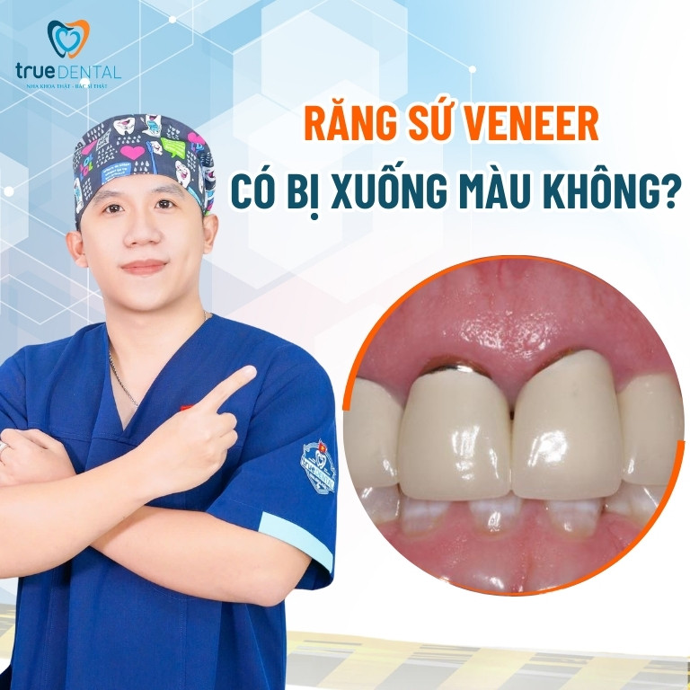 THẨM MỸ RĂNG SỨ VENEER CÓ BỊ XUỐNG MÀU THEO THỜI GIAN KHÔNG? 1 Răng sứ Veneer có bị xuống màu không?
