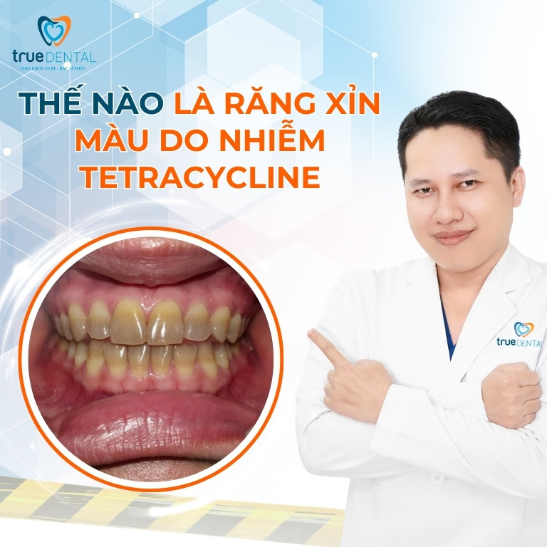 RĂNG XỈN MÀU DO NHIỄM TETRACYCLINE CÓ DÁN SỨ VENEER ĐƯỢC KHÔNG? 2 Thế nào là răng xỉn màu do nhiễm Tetracycline?