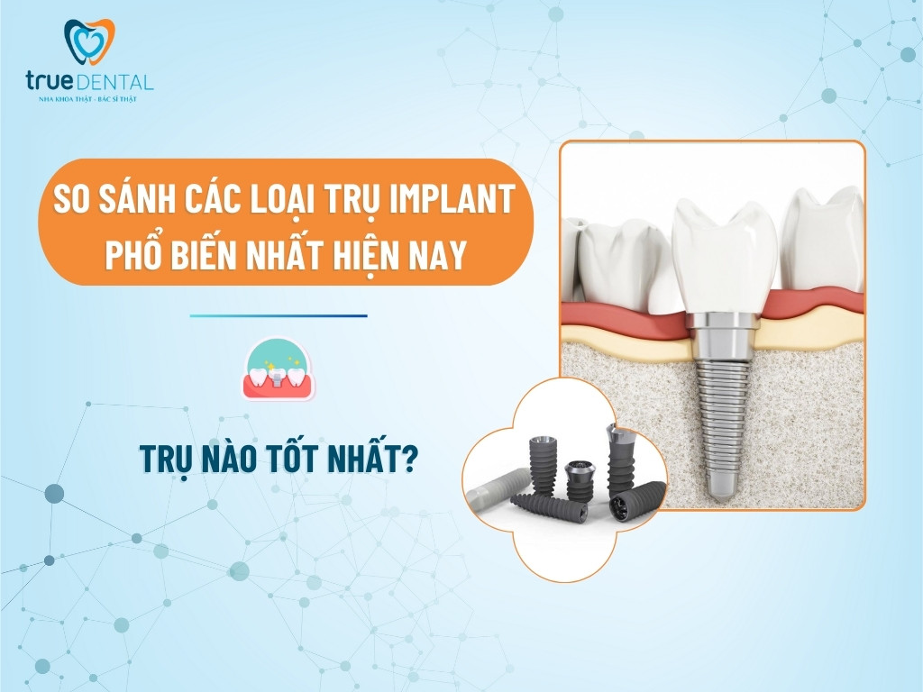 SO SÁNH CÁC LOẠI TRỤ IMPLANT PHỔ BIẾN NHẤT HIỆN NAY: TRỤ NÀO TỐT NHẤT? 4 SO SÁNH CÁC LOẠI TRỤ IMPLANT PHỔ BIẾN NHẤT HIỆN NAY: TRỤ NÀO TỐT NHẤT?