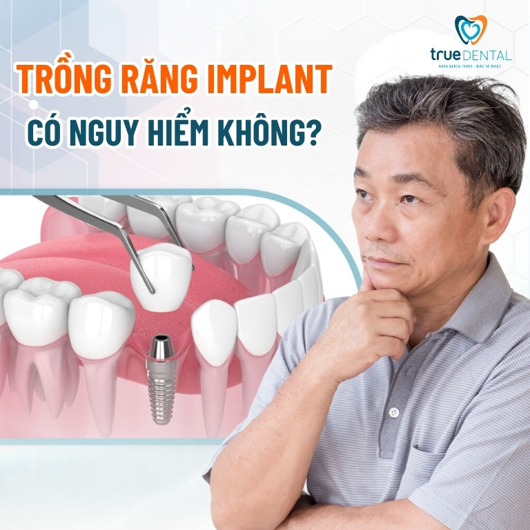 CẢNH BÁO TÁC HẠI CỦA VIỆC TRỒNG RĂNG IMPLANT GIÁ RẺ 2 Trồng răng Implant có nguy hiểm không?