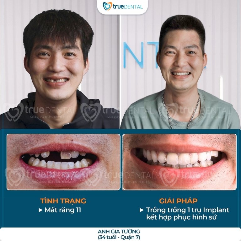 TRỒNG IMPLANT RĂNG CỬA: NHỮNG LƯU Ý CẦN BIẾT TRƯỚC KHI THỰC HIỆN 3 hình ảnh trước và sau khi trồng implant cho răng cửa