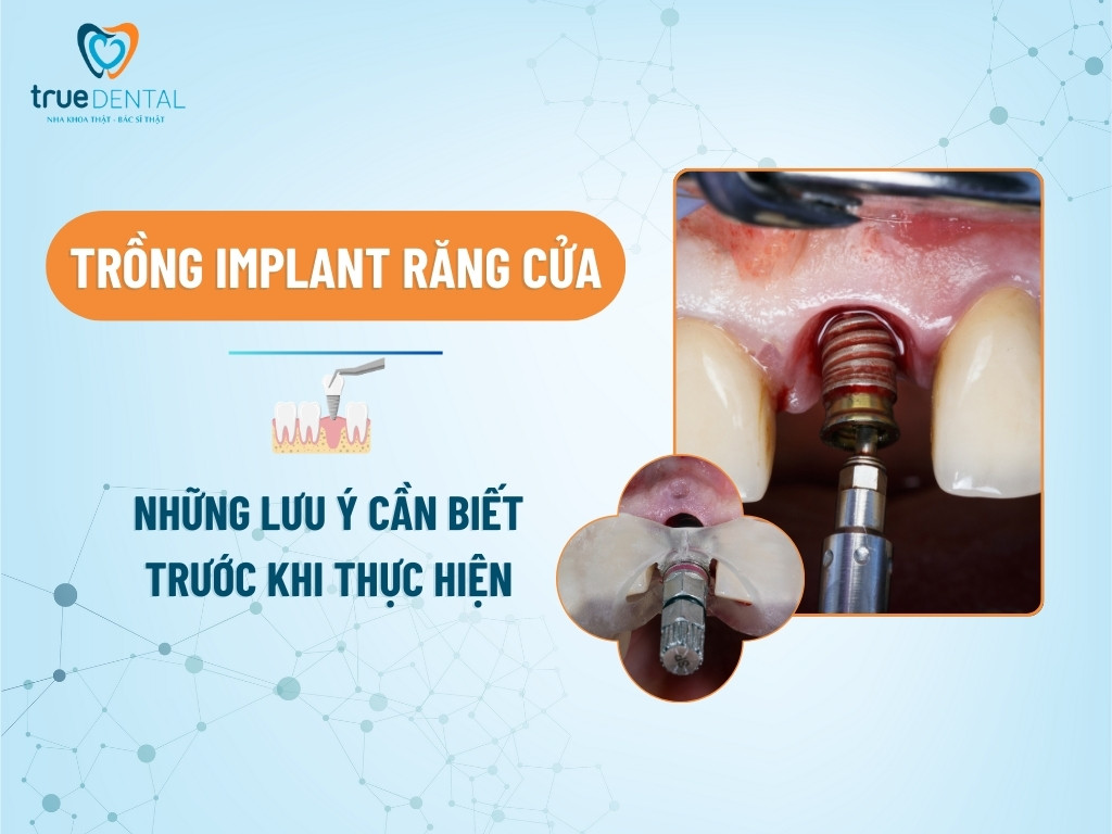 TRỒNG IMPLANT RĂNG CỬA: NHỮNG LƯU Ý CẦN BIẾT TRƯỚC KHI THỰC HIỆN 2 TRỒNG IMPLANT RĂNG CỬA: NHỮNG LƯU Ý CẦN BIẾT TRƯỚC KHI THỰC HIỆN