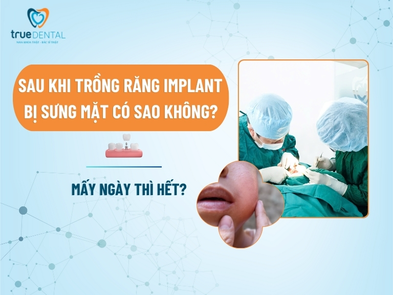 SAU KHI TRỒNG RĂNG IMPLANT BỊ SƯNG MẶT CÓ SAO KHÔNG? MẤY NGÀY THÌ HẾT? 3 SAU KHI TRỒNG RĂNG IMPLANT BỊ SƯNG MẶT CÓ SAO KHÔNG? MẤY NGÀY THÌ HẾT?