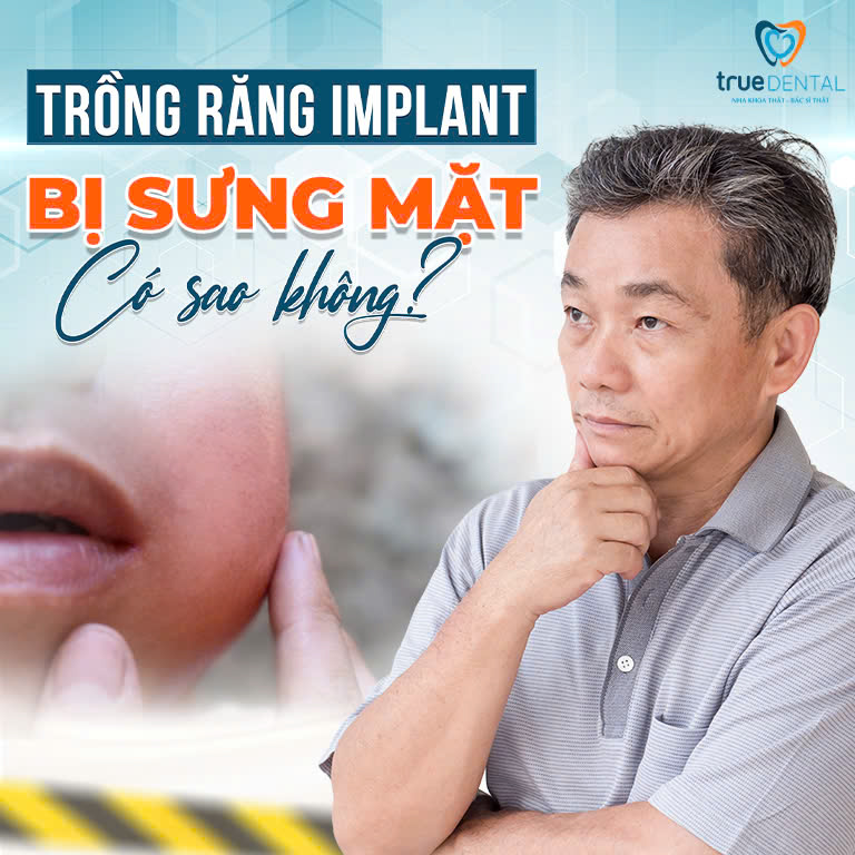 SAU KHI TRỒNG RĂNG IMPLANT BỊ SƯNG MẶT CÓ SAO KHÔNG? MẤY NGÀY THÌ HẾT? 1 trồng răng Implant bị sưng mặt có sao không