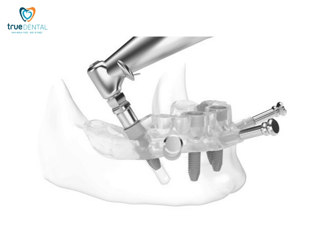 trồng răng Implant máng định vị phẫu thuật có niềng răng được không