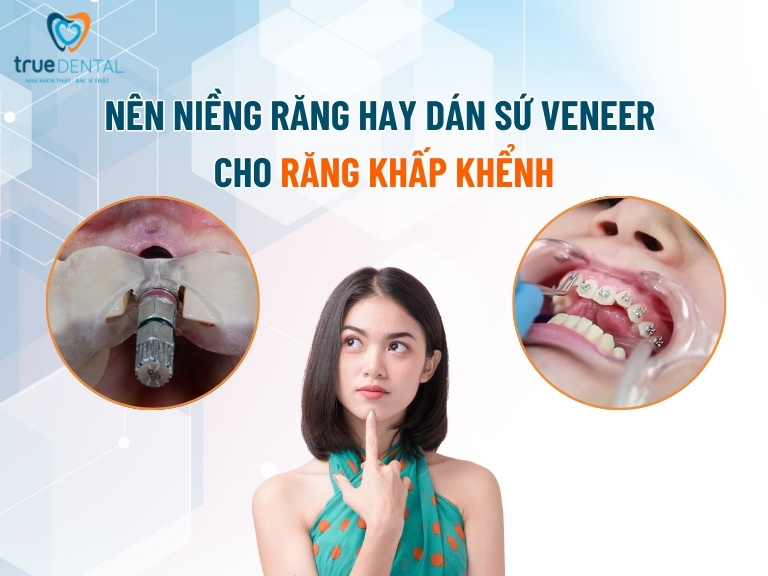 Nên niềng răng trước hay cấy ghép Implant trước