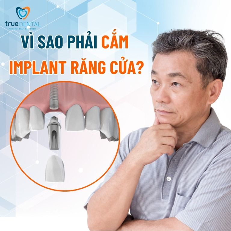 CẮM IMPLANT RĂNG CỬA: QUY TRÌNH THỰC HIỆN VÀ NHỮNG ĐIỀU CẦN BIẾT 1 Vì sao phải cắm implant răng cửa?