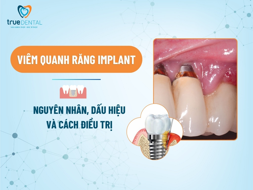 VIÊM QUANH RĂNG IMPLANT: NGUYÊN NHÂN, DẤU HIỆU VÀ CÁCH ĐIỀU TRỊ 7 VIÊM QUANH RĂNG IMPLANT: NGUYÊN NHÂN, DẤU HIỆU VÀ CÁCH ĐIỀU TRỊ