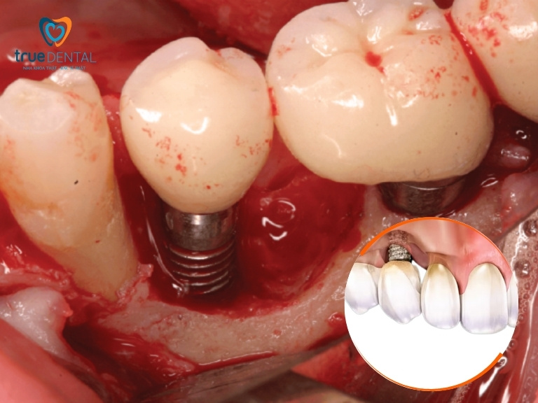 VIÊM QUANH RĂNG IMPLANT: NGUYÊN NHÂN, DẤU HIỆU VÀ CÁCH ĐIỀU TRỊ 1 viêm quanh răng Implant