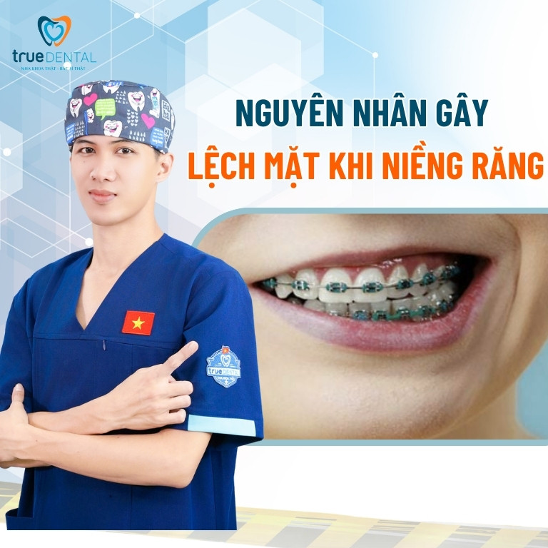 NGUYÊN NHÂN BỊ LỆCH MẶT KHI NIỀNG RĂNG VÀ CÁCH KHẮC PHỤC 2 Nguyên nhân gây lệch mặt khi niềng răng
