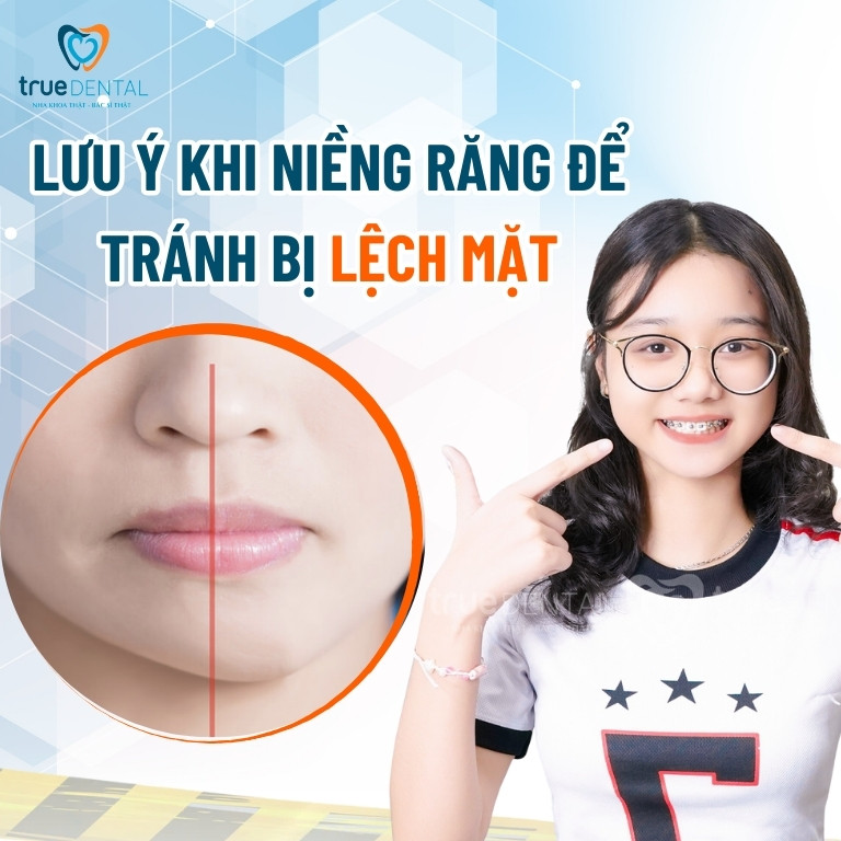 NGUYÊN NHÂN BỊ LỆCH MẶT KHI NIỀNG RĂNG VÀ CÁCH KHẮC PHỤC 4 Lưu ý khi niềng răng để tránh bị lệch mặt
