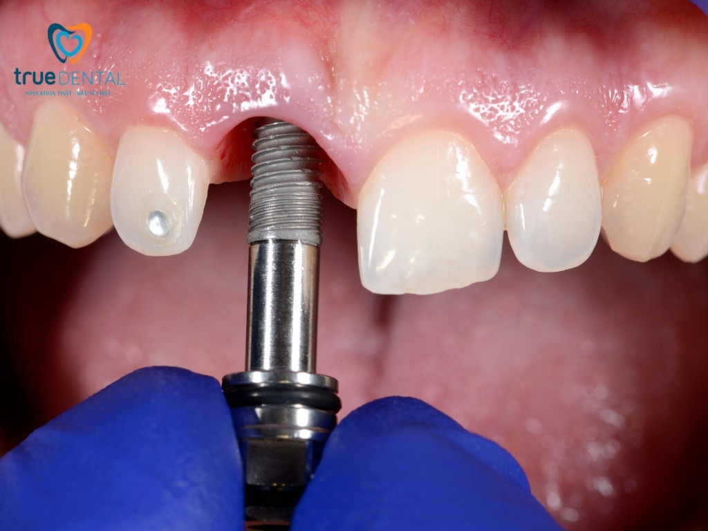 NHỮNG BIẾN CHỨNG KHI CẤY GHÉP IMPLANT KHÔNG ĐÚNG CÁCH BẠN CẦN BIẾT 1 Tổng quan về kỹ thuật cấy ghép Implant