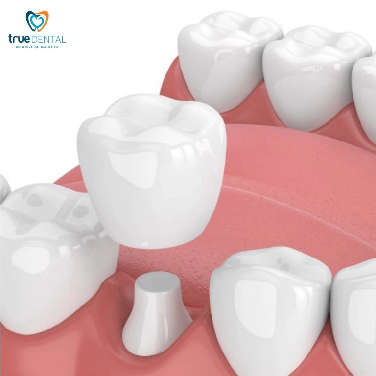 SAU KHI BỌC RĂNG SỨ CÓ NIỀNG ĐƯỢC KHÔNG? GIẢI ĐÁP TỪ BÁC SĨ TRUE DENTAL 1 Bọc răng sứ là gì?