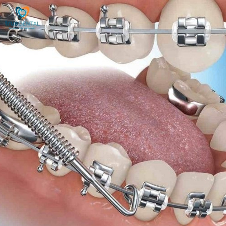 Trị móm tại nhà bằng cách nào? Có nên tự điều trị tại nhà không? 3 Niềng răng là gì?