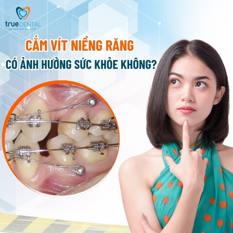 CẮM VÍT NIỀNG RĂNG LÀ GÌ? CÓ ĐAU KHÔNG VÀ KHI NÀO CẦN THỰC HIỆN 4 Cắm vít niềng răng có ảnh hưởng gì đến sức khỏe không?