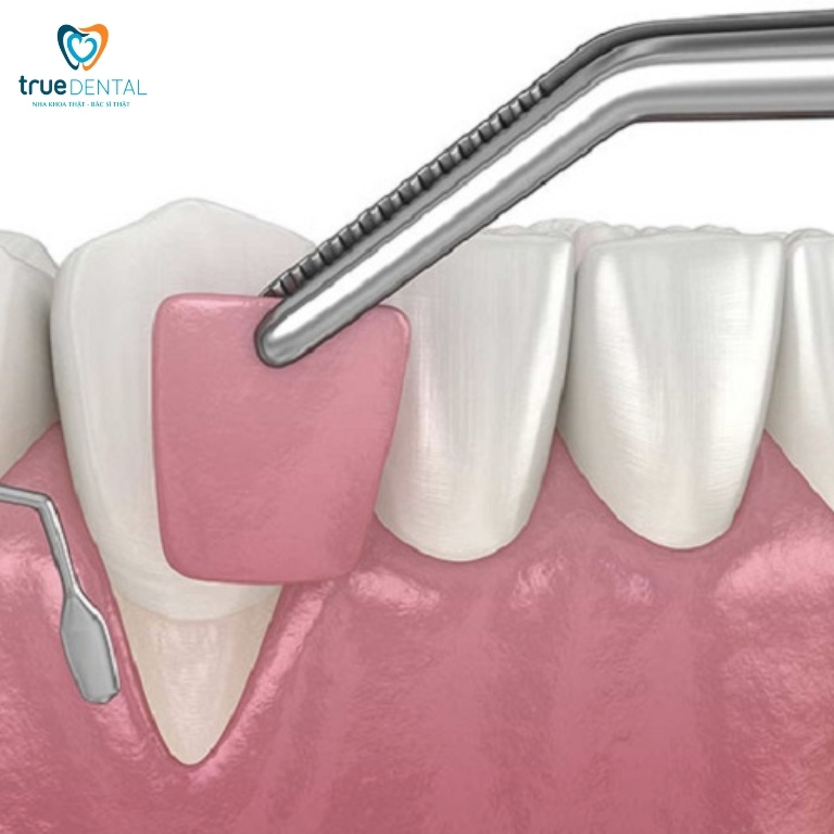 GHÉP NƯỚU LÀ GÌ? TRỒNG RĂNG IMPLANT CÓ CẦN GHÉP NƯỚU KHÔNG? 1 Ghép nướu là gì?