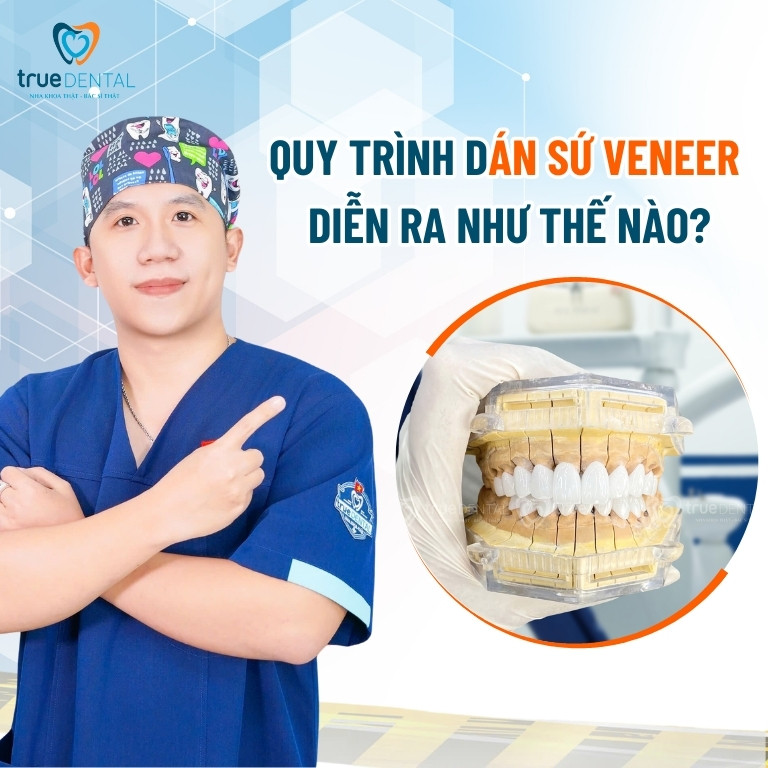 5 LỢI ÍCH KHI DÁN SỨ VENEER BẠN NÊN BIẾT 3 lợi ích khi dán sứ Veneer đúng quy trình