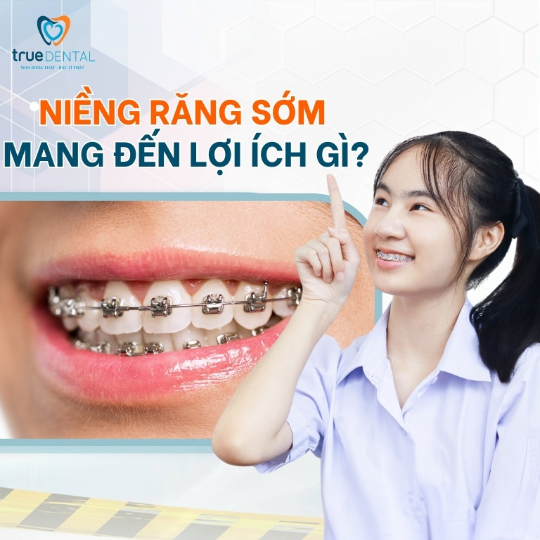 7 LỢI ÍCH KHI NIỀNG RĂNG SỚM CHO TRẺ BẠN NÊN BIẾT 3 7 lợi ích khi niềng răng sớm cho trẻ
