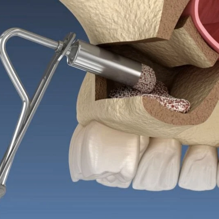 Nâng xoang hở trong cấy ghép Implant là gì? Có đau không? 1 Nâng xoang hở trong cấy ghép Implant