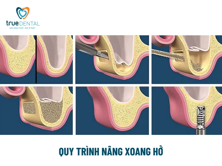 Nâng xoang hở trong cấy ghép Implant là gì? Có đau không? 2 Quy trình thực hiện nâng xoang hở