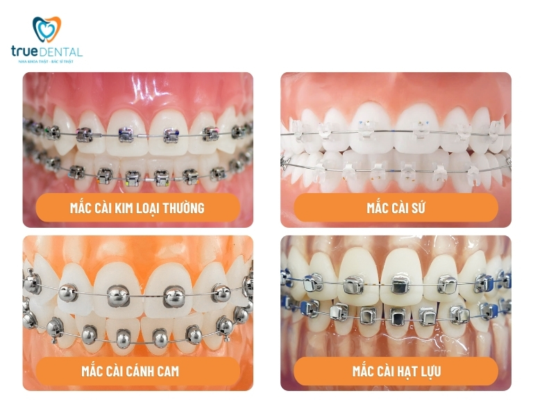 Tư vấn niềng răng - Thông tin giải đáp chi tiết từ Bác sĩ True Dental 5 Niềng răng mắc cài
