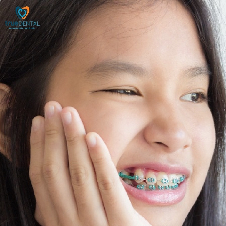 NIỀNG RĂNG BỊ HỎNG: DẤU HIỆU VÀ CÁCH KHẮC PHỤC BẠN NÊN BIẾT 1 Thế nào là một ca niềng răng bị hỏng