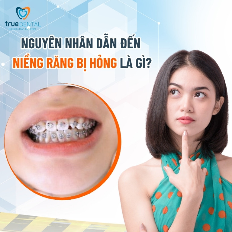 NIỀNG RĂNG BỊ HỎNG: DẤU HIỆU VÀ CÁCH KHẮC PHỤC BẠN NÊN BIẾT 3 Nguyên nhân dẫn đến niềng răng bị hỏng